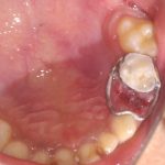 a2. Band and loop post