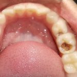 b1. Lingual arch pre