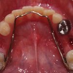 b2. Lingual arch post