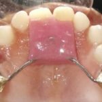 c2. Modified nance post