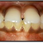 3.2b lip bumper -min