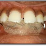 3.2c lip bumper final-min