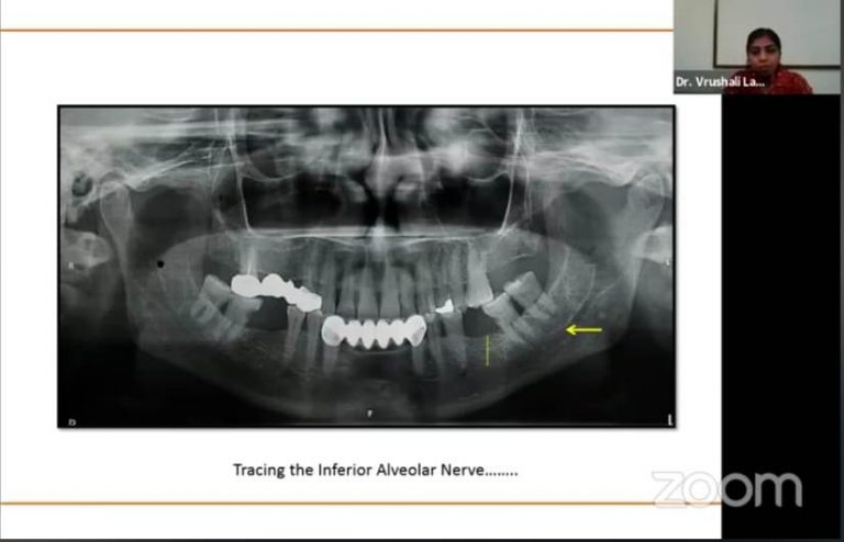 Speaker Dr. Vrushali Lathiya conducting lecture on Diagnostic imaging in periodontal disease